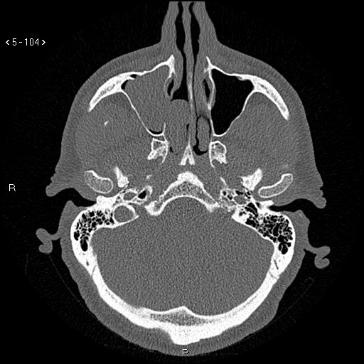 Antrochoanal Polyp (Radiopaedia 70510-80631 Axial bone window 52).jpg