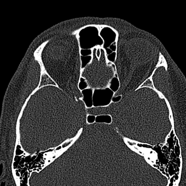 Antrochoanal polyp (Radiopaedia 30002-30554 Axial bone window 43).jpg