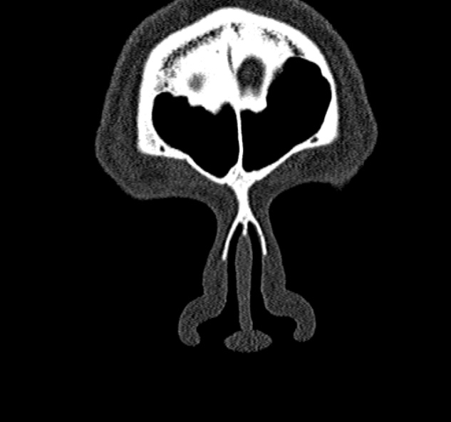 Antrochoanal polyp (Radiopaedia 30002-30554 Coronal bone window 9).jpg