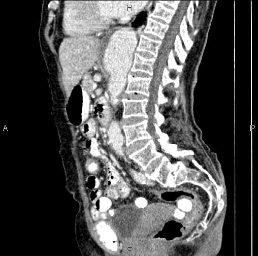 File:Aortic aneurysm and Lemmel syndrome (Radiopaedia 86499-102554 D 47).jpg