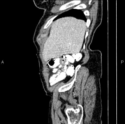 File:Aortic aneurysm and Lemmel syndrome (Radiopaedia 86499-102554 D 9).jpg