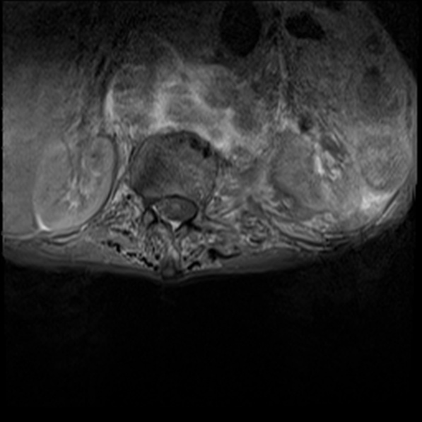 File:Aortic aneurysm with spinal destruction (Radiopaedia 42301-45409 Axial T1 fat sat 5).jpg