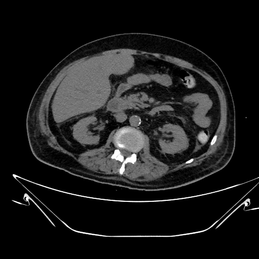 Aortic arch aneurysm (Radiopaedia 84109-99365 Axial non-contrast 335).jpg