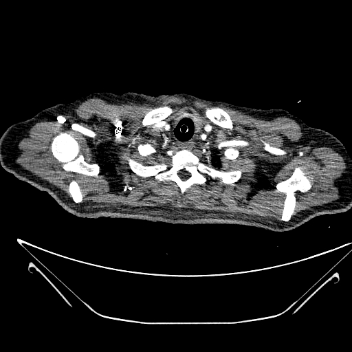 Aortic arch aneurysm (Radiopaedia 84109-99365 B 60).jpg