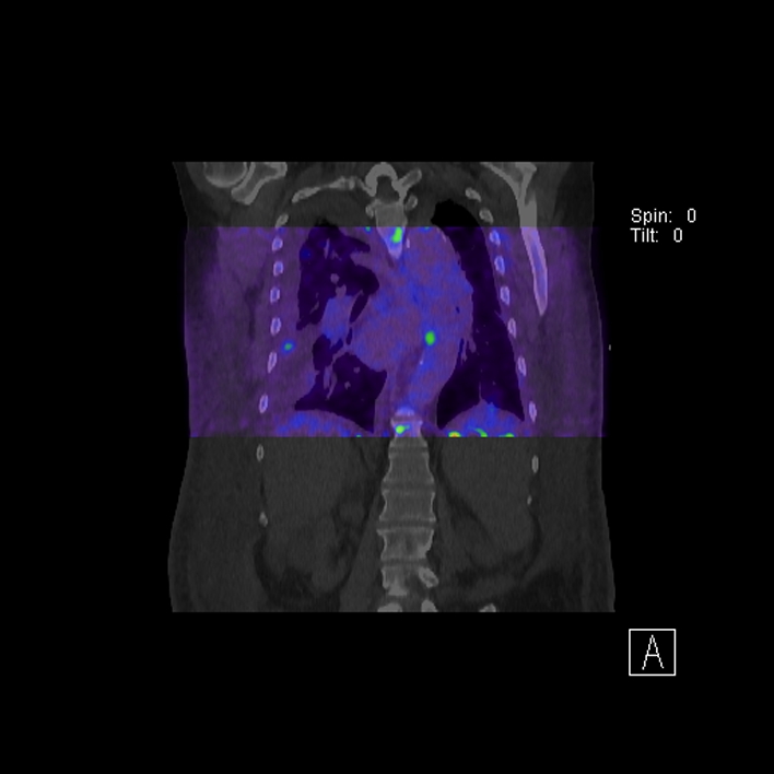 Aortic arch graft infection (FDG PET-CT) (Radiopaedia 71975-82438 D 59).jpg