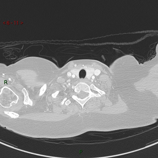 Aortic arch origin of left vertebral artery (Radiopaedia 51520-57286 Axial lung window 11).jpg