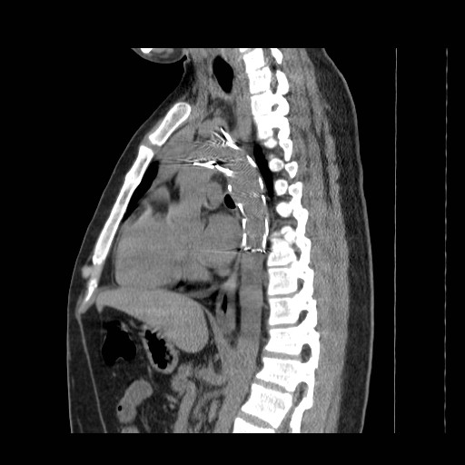 File:Aortic arch stent (Radiopaedia 30030-30595 B 12).jpg