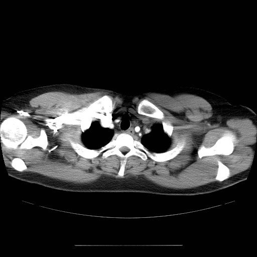 File:Aortic arch stent (Radiopaedia 30030-30595 D 2).jpg