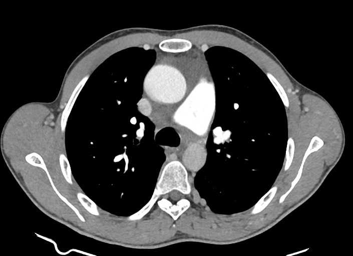 File:Aortic coarctation with aneurysm (Radiopaedia 74818-85828 A 132).jpg