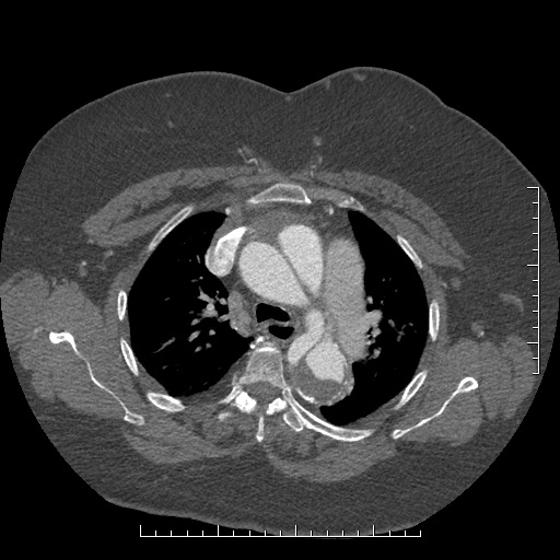 File:Aortic dissection- Stanford A (Radiopaedia 35729-37268 A 24).jpg