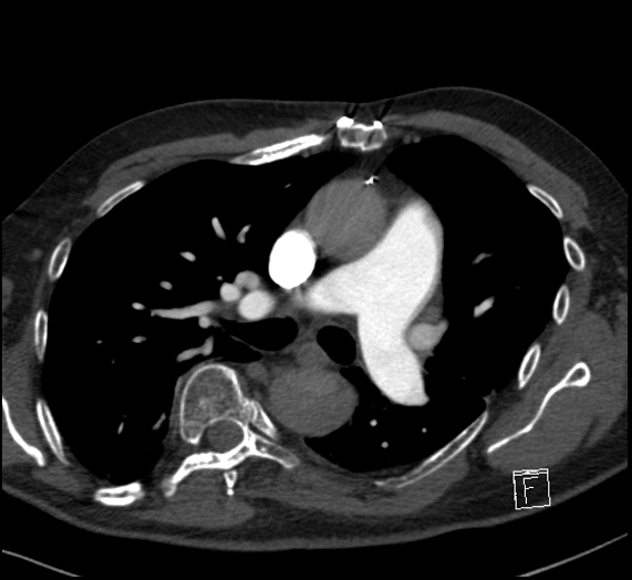 File:Aortic dissection (CTPA) (Radiopaedia 75506-86751 Axial C+ CTPA 62).jpg