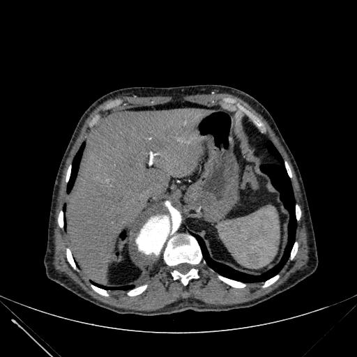 Aortic dissection (Radiopaedia 27466-27665 C+ arterial phase 263).jpg