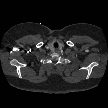 File:Aortic dissection (Radiopaedia 57969-64959 A 21).jpg