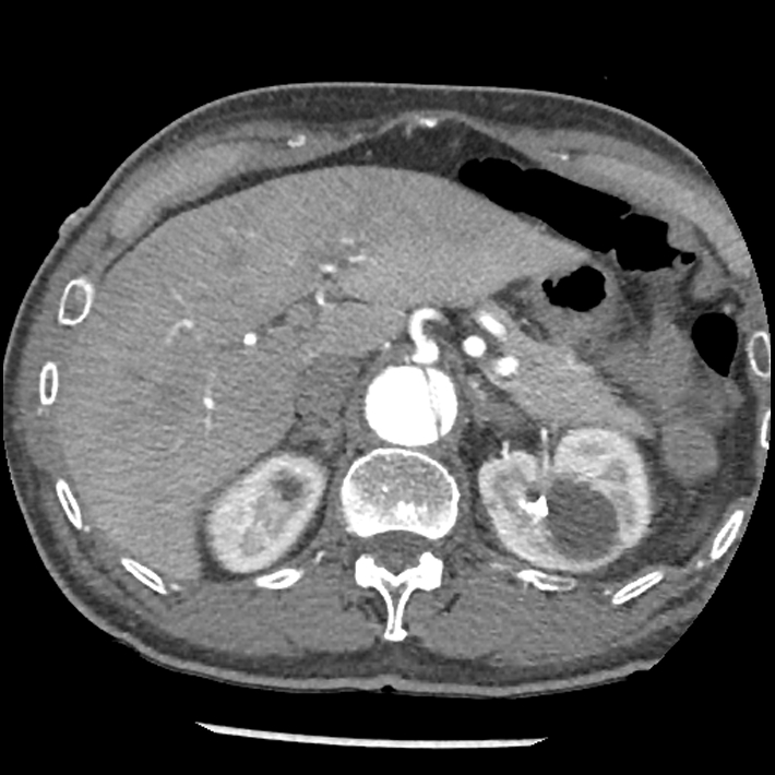 Aortic dissection - DeBakey Type I-Stanford A (Radiopaedia 79863-93115 A 41).jpg
