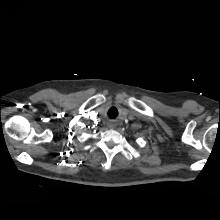 Aortic dissection with rupture into pericardium (Radiopaedia 12384-12647 A 5).jpg