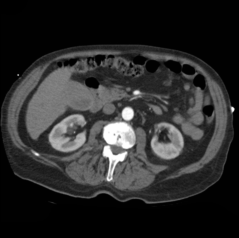 Aortic dissection with rupture into pericardium (Radiopaedia 12384-12647 A 63).jpg
