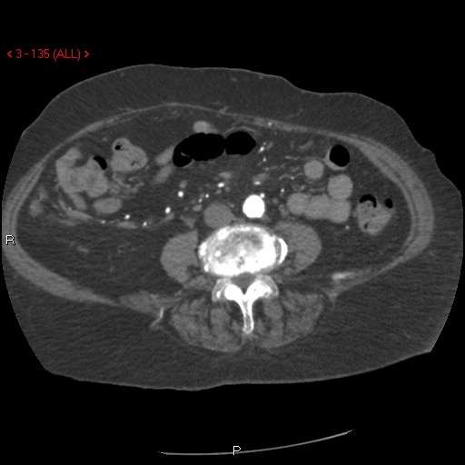 File:Aortic intramural hematoma (Radiopaedia 27746-28001 A 135).jpg