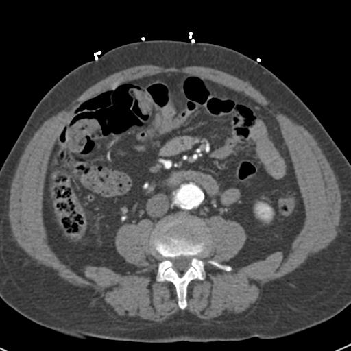 Aortic intramural hematoma (Radiopaedia 31139-31838 B 115).jpg