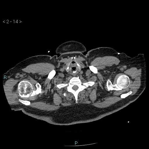 Aortic intramural hematoma (Radiopaedia 48463-53380 Axial non-contrast 6).jpg