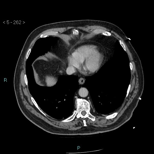 Aortic intramural hematoma (Radiopaedia 48463-53380 C 118).jpg