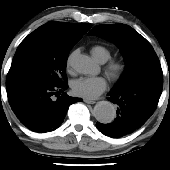 Aortic intramural hematoma (type B) (Radiopaedia 79323-92387 Axial non-contrast 30).jpg