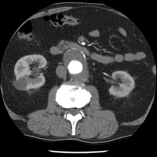 File:Aortic intramural hematoma (type B) (Radiopaedia 79323-92387 B 71).jpg