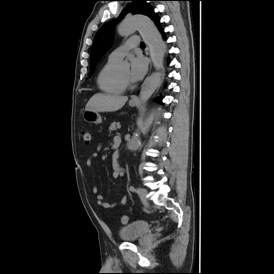 Aortic intramural hematoma (type B) (Radiopaedia 79323-92387 G 30).jpg