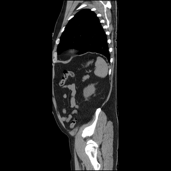 Aortic intramural hematoma (type B) (Radiopaedia 79323-92387 G 46).jpg