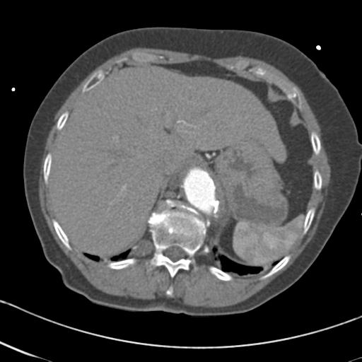 Aortic intramural hematoma from penetrating atherosclerotic ulcer (Radiopaedia 31137-31836 A 72).jpg