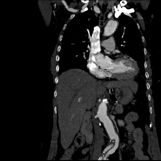 File:Aortic intramural hematoma from penetrating atherosclerotic ulcer (Radiopaedia 31137-31836 C 28).jpg