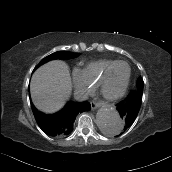 Aortic intramural hematoma with dissection and intramural blood pool (Radiopaedia 77373-89491 Axial non-contrast 72).jpg