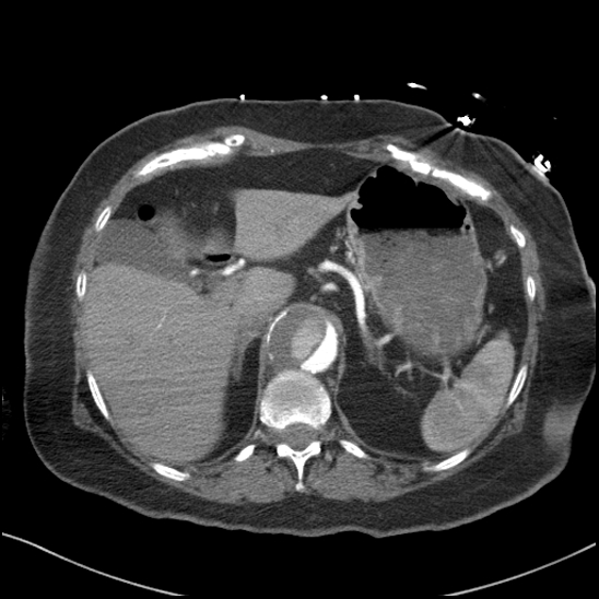 Aortic intramural hematoma with dissection and intramural blood pool (Radiopaedia 77373-89491 B 107).jpg