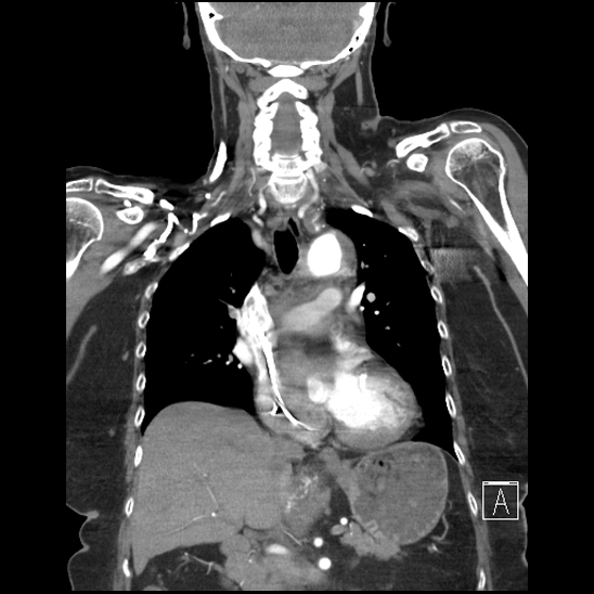 Aortic intramural hematoma with dissection and intramural blood pool (Radiopaedia 77373-89491 C 29).jpg