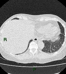 File:Aortic valve endocarditis (Radiopaedia 87209-103485 Axial lung window 82).jpg