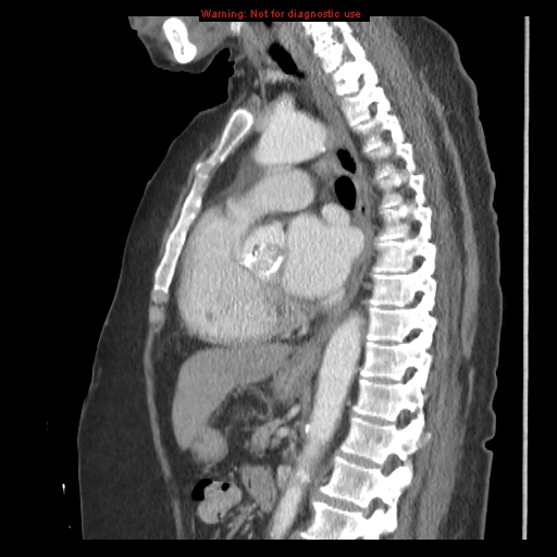File:Aortic valve stenosis (Radiopaedia 14480-14423 B 4).jpg