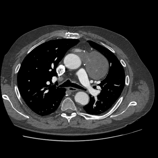File:Aorto-coronary bypass graft aneurysms (Radiopaedia 40562-43157 A 45).png