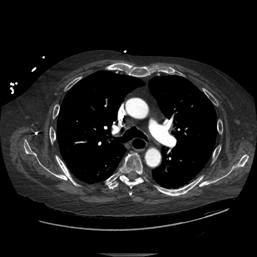 Aortoesophageal fistula with endovascular repair (Radiopaedia 73781-84592 Axial C+ CTPA 53).jpg