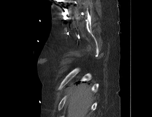 Aortoesophageal fistula with endovascular repair (Radiopaedia 73781-84592 Sagittal C+ CTPA 4).jpg
