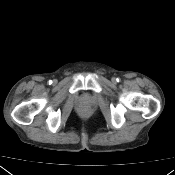 Aortoiliac occlusive disease (Radiopaedia 32134-33076 Axial non-contrast 54).jpg