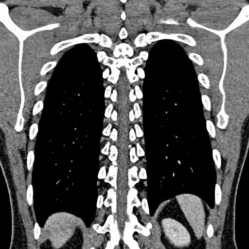 File:Apical lung mass mimic - neurogenic tumor (Radiopaedia 59918-67521 B 86).jpg