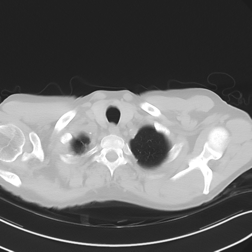 Apical pulmonary metastasis (Radiopaedia 46338-50754 Axial non-contrast 8).png