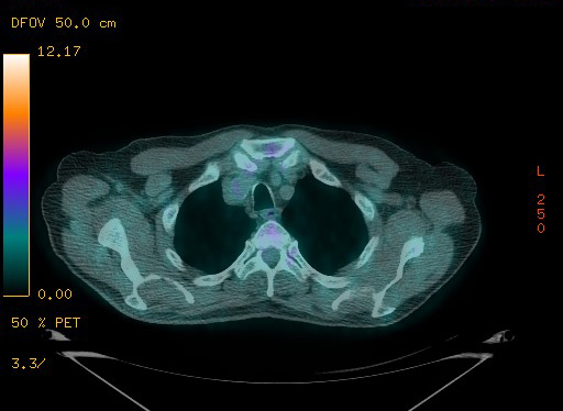 Appendiceal adenocarcinoma complicated by retroperitoneal abscess (Radiopaedia 58007-65041 Axial PET-CT 41).jpg