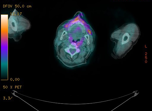Appendiceal adenocarcinoma complicated by retroperitoneal abscess (Radiopaedia 58007-65041 Axial PET-CT 5).jpg
