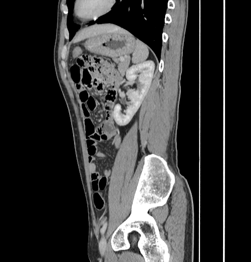 Appendiceal mucinous adenocarcinoma (Radiopaedia 66605-75922 C 49).jpg