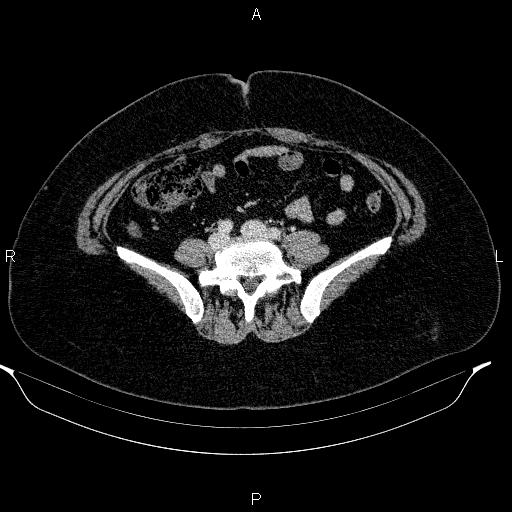 Appendiceal mucocele (Radiopaedia 83280-97688 Axial With contrast 71).jpg