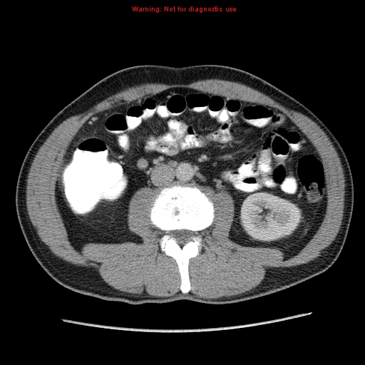 File:Appendicitis and renal cell carcinoma (Radiopaedia 17063-16760 A 30).jpg