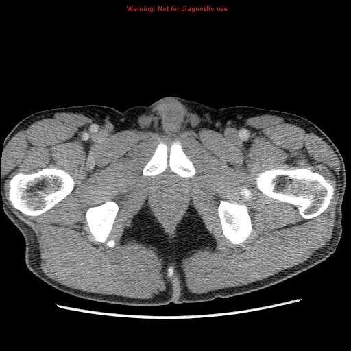 File:Appendicitis and renal cell carcinoma (Radiopaedia 17063-16760 A 59).jpg