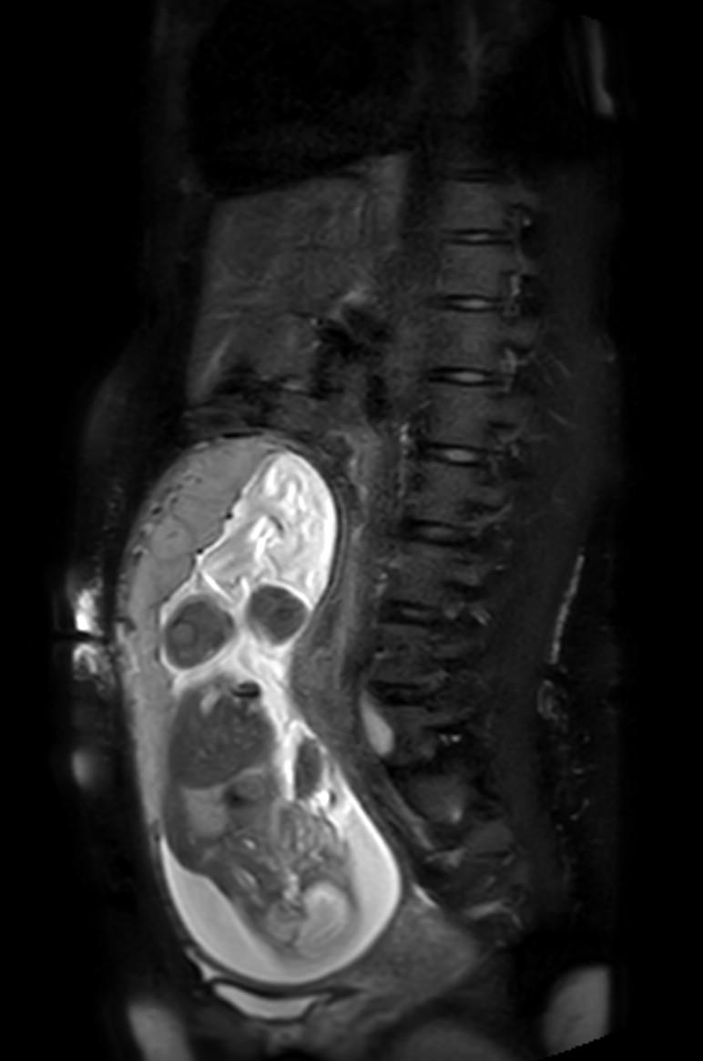 Appendicitis in gravida (MRI) (Radiopaedia 89433-106395 Sagittal T2 SPAIR 28).jpg
