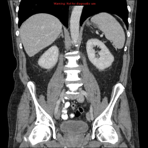 File:Appendicitis mass in inguinal hernia (Radiopaedia 26858-27029 B 46).jpg
