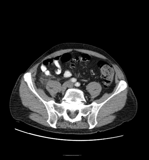 Appendicitis with localized perforation and abscess formation (Radiopaedia 49035-54130 A 64).jpg